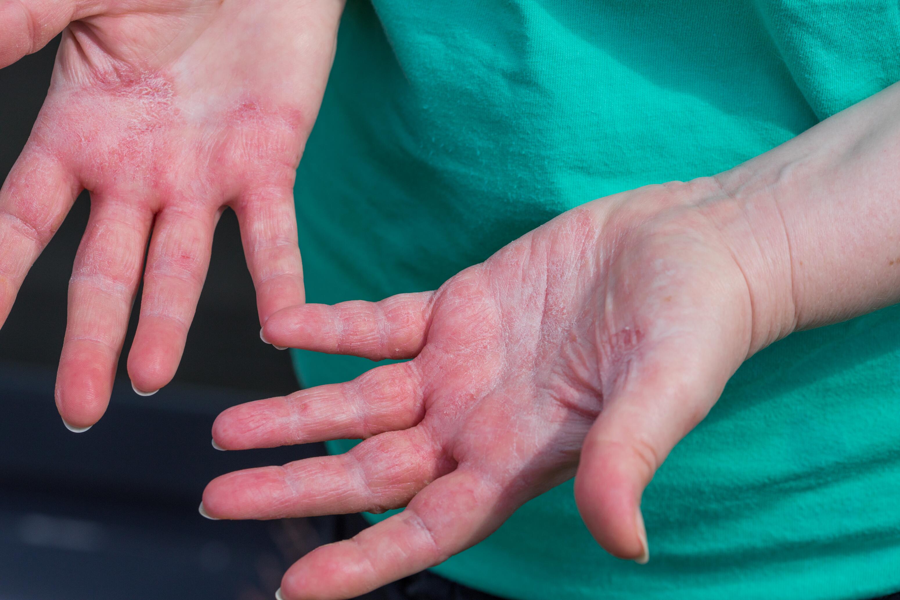 Adults with chronic eczema on the inside of their hands